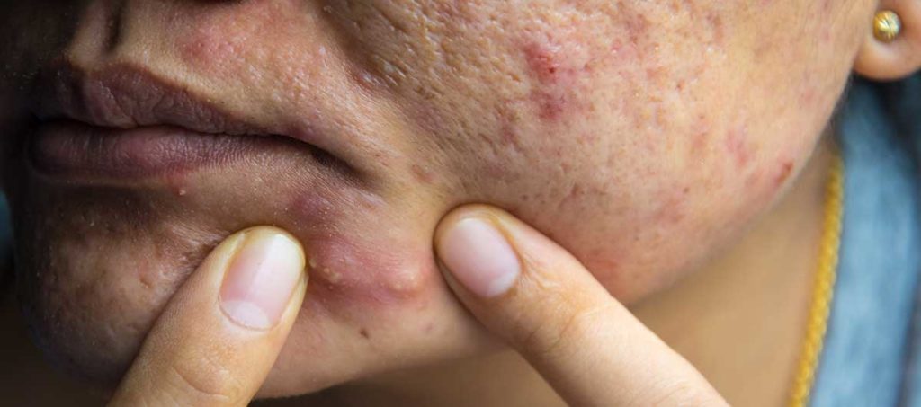 What are hard pimples?