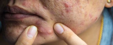 What are hard pimples?