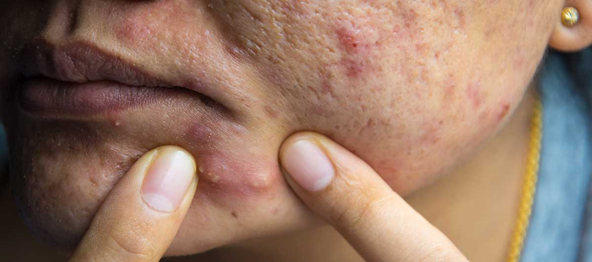 Hard Painful Pimples Under The Skin