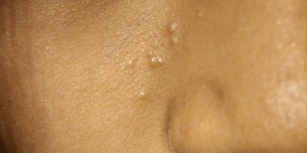 What are the bumps on my face that aren't pimples?