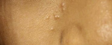 What are the bumps on my face that aren't pimples?