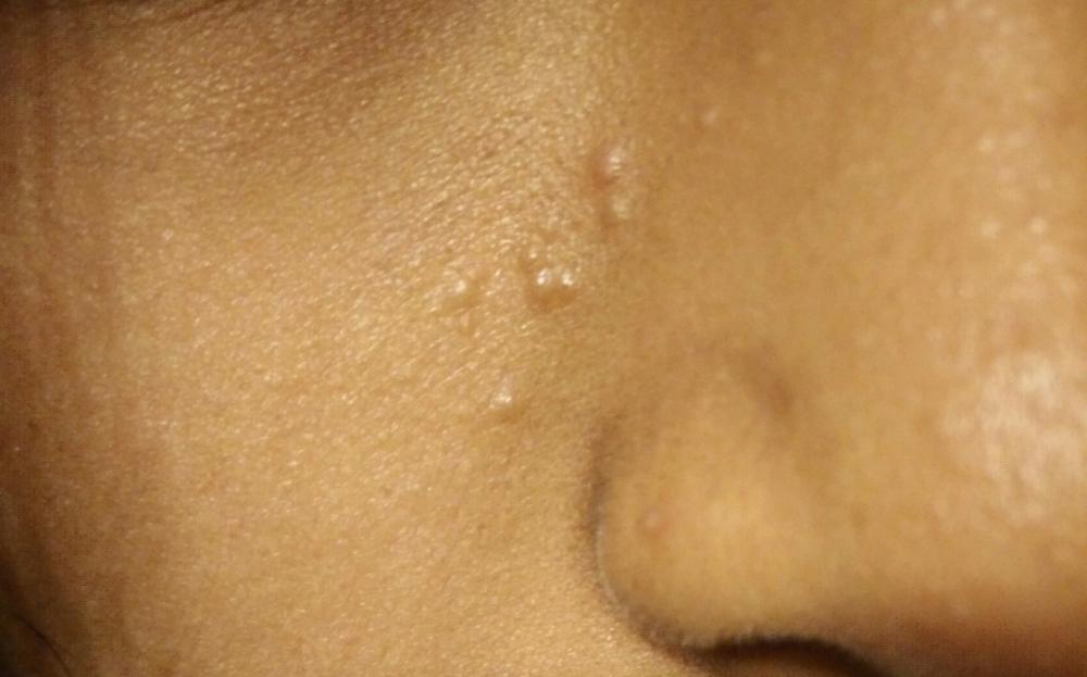 What are the bumps on my face that aren't pimples?