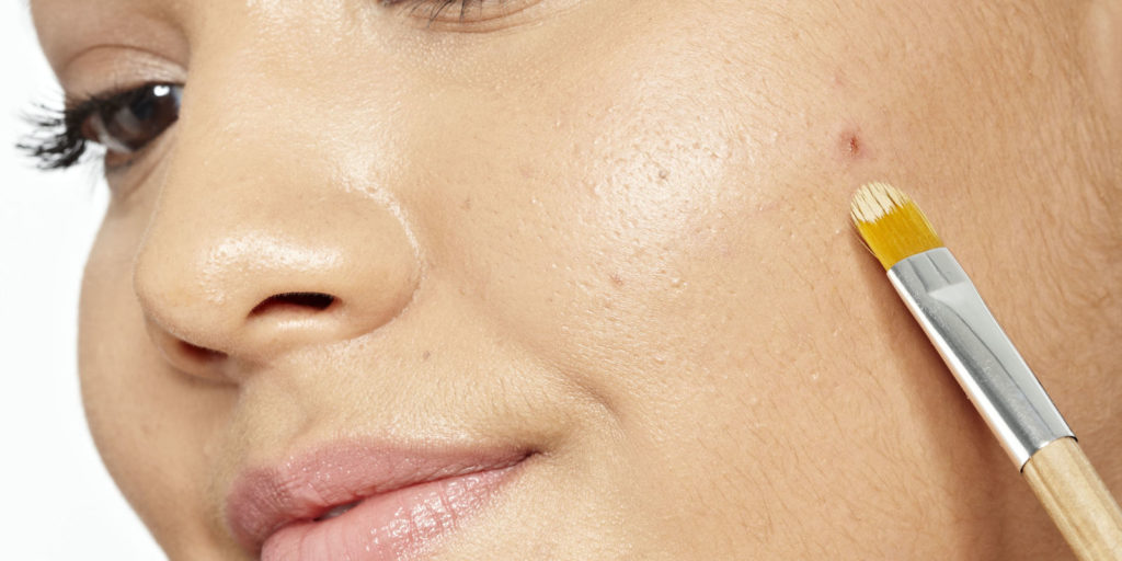 What dries up a pimple?