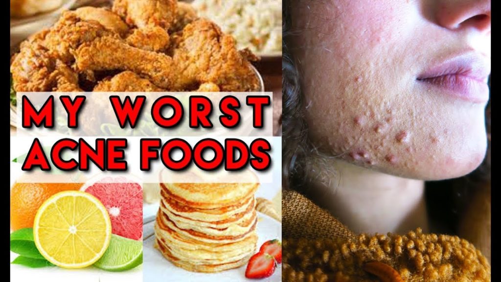 What foods cause back acne?