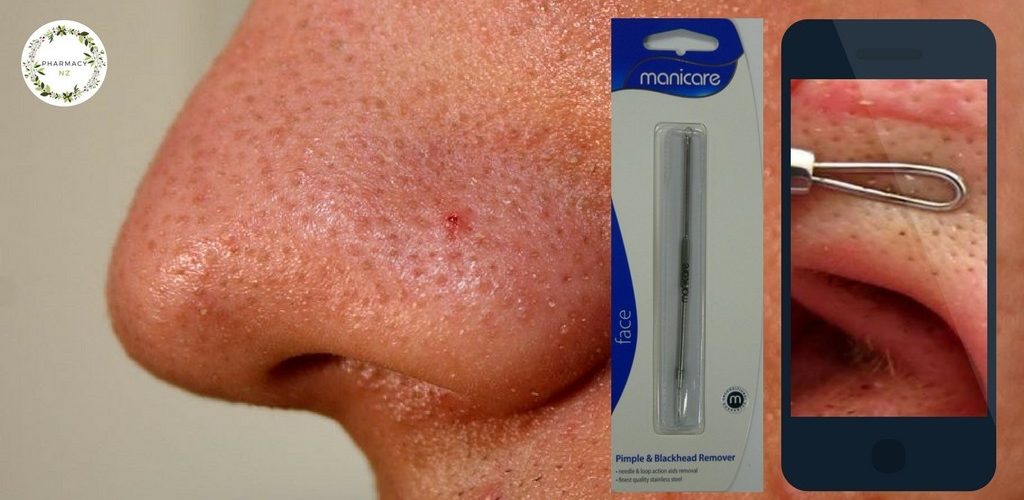 What is the best blackhead remover?