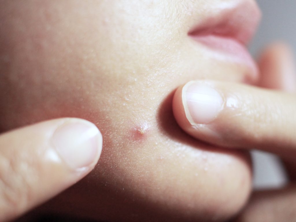 What is the hard white stuff in a pimple?