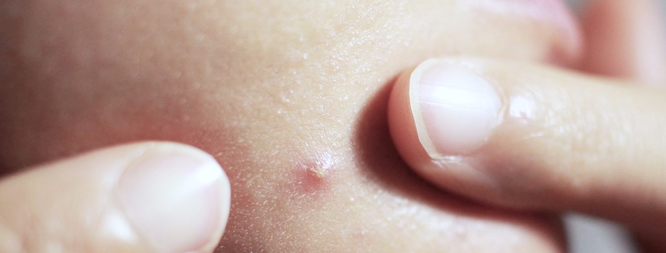 What is the hard white stuff in a pimple?