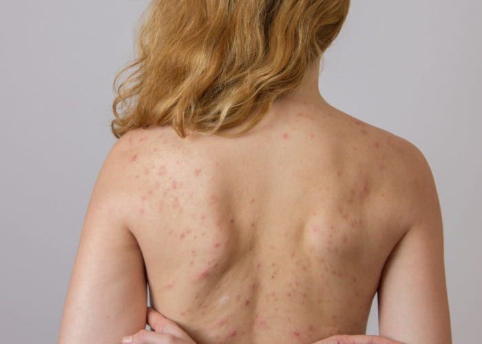 Why do I have so much back acne?