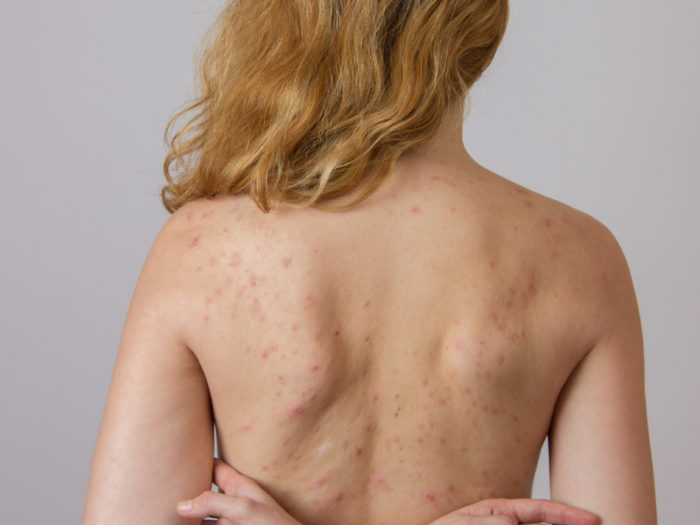 Why do I have so much back acne?