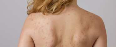 Why is my body acne so bad?