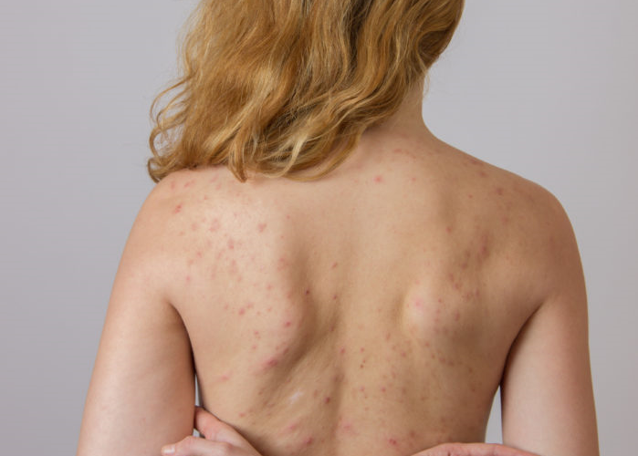Why is my body acne so bad?