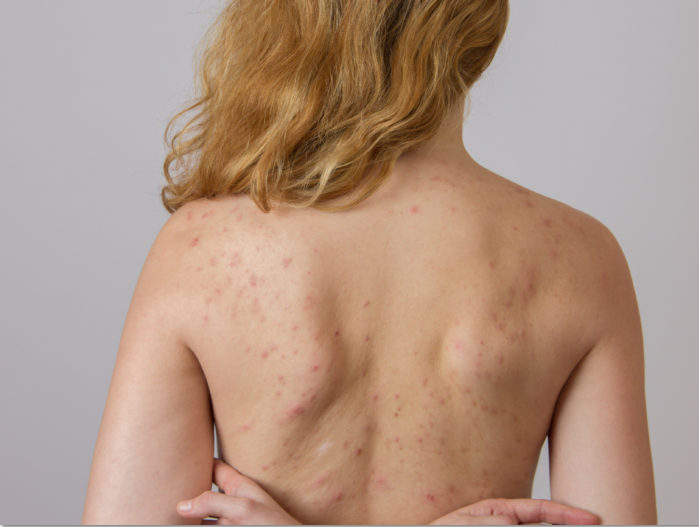 Why is my body acne so bad?