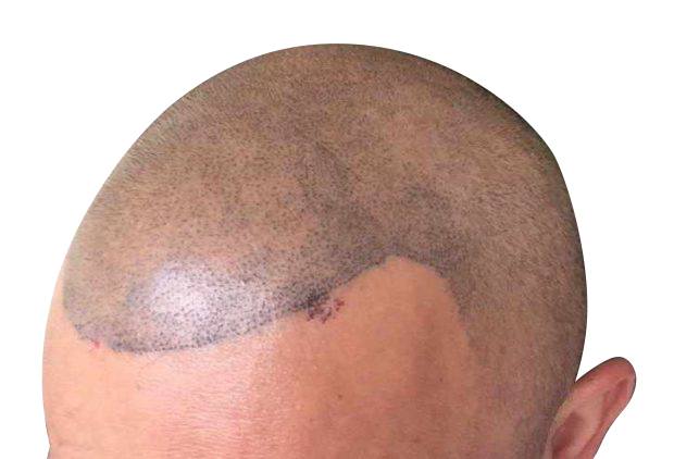 Will I regret scalp micropigmentation?